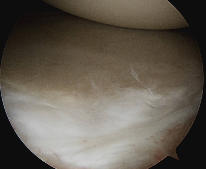 Shoulder Arthroscopy Posterior Labrum